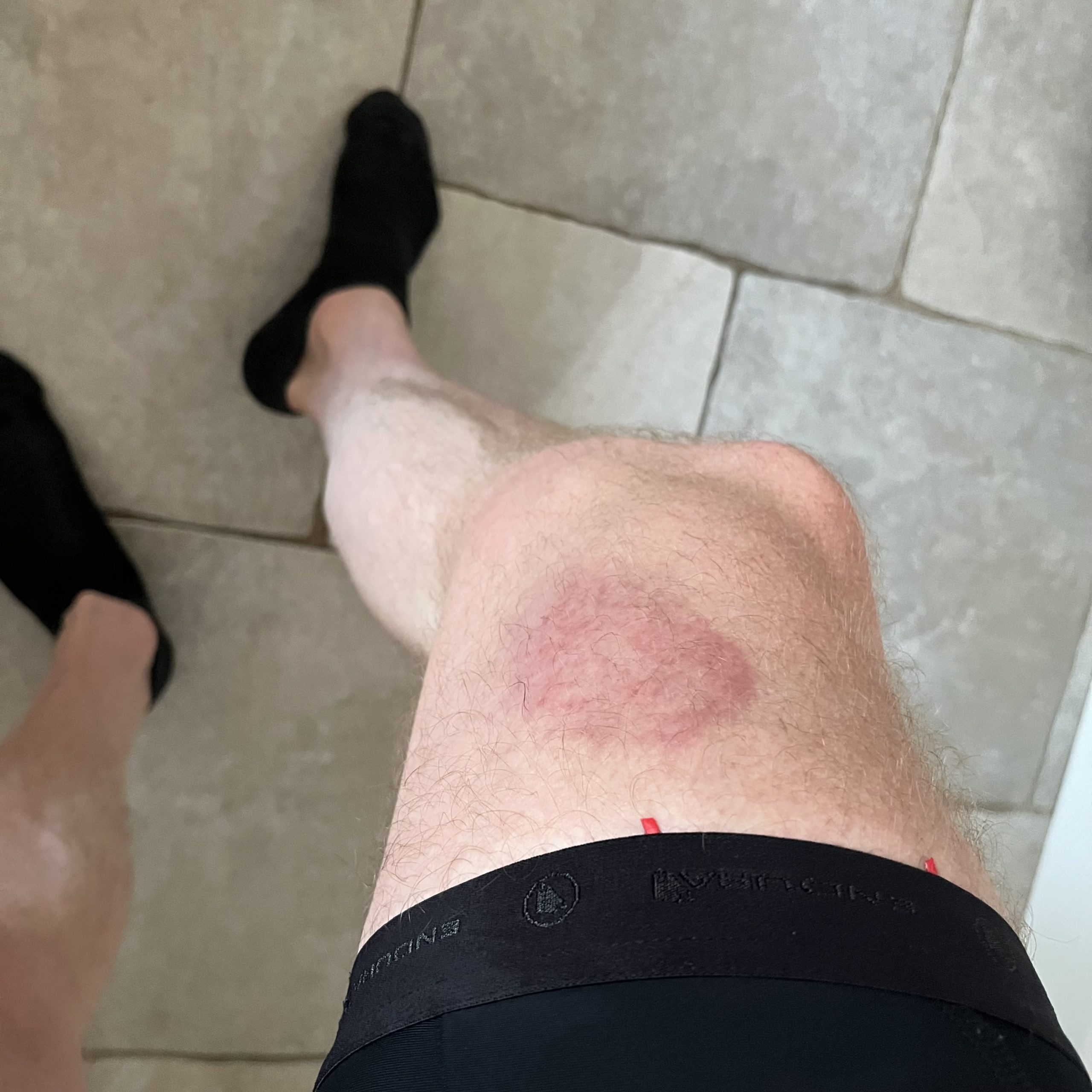 Horsefly bites are the gifts that keep on giving
